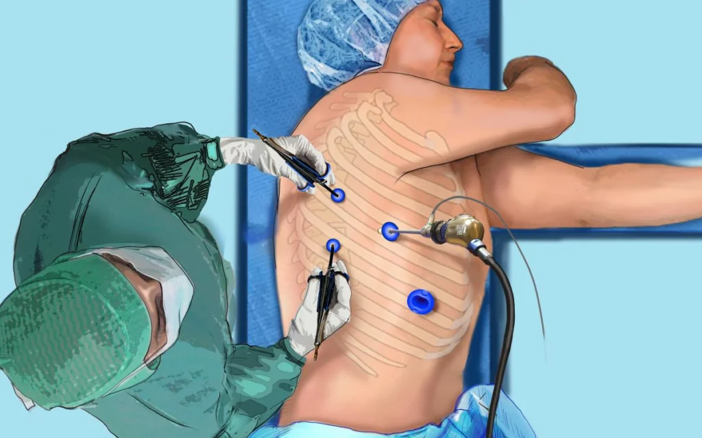 Thoracic VATS Procedures